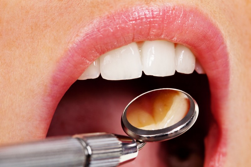 Composite Fillings