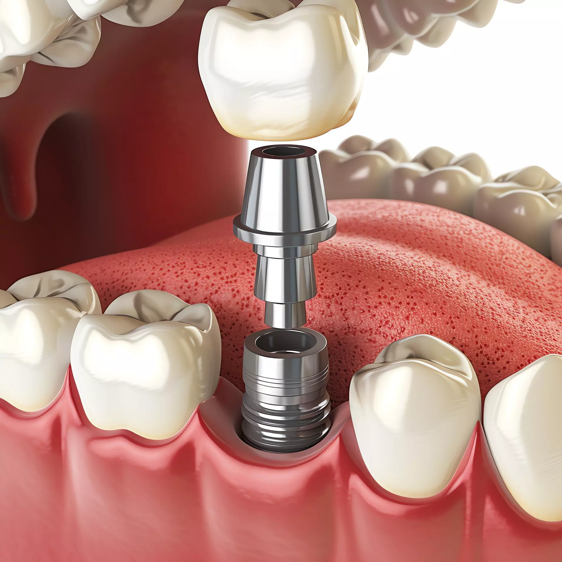 Implants